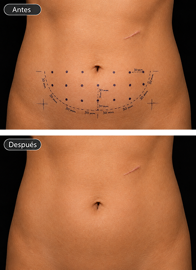 Lipo Ala&Iuml;a Pro